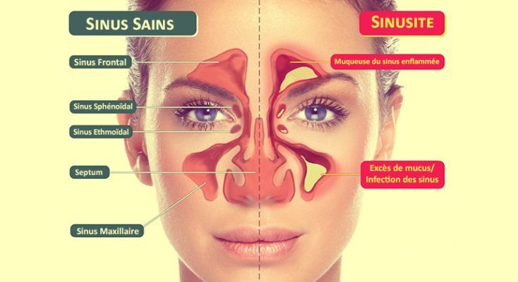 Traiter la Sinusite avec des Huiles essentielles