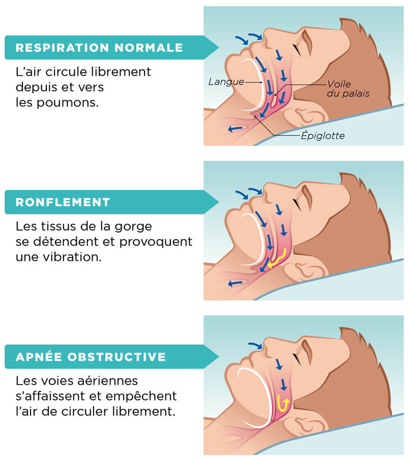 Apnées du sommeil : Trouver un soulagement naturel grâce à la naturopathie